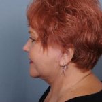 Facelift Before & After Patient #1030