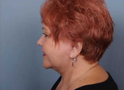 Facelift Before & After Patient #1030