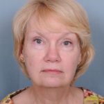 Facelift Before & After Patient #981