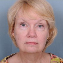 Facelift Before & After Patient #981