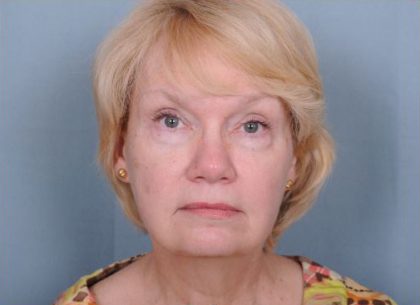 Facelift Before & After Patient #981