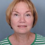 Facelift Before & After Patient #981