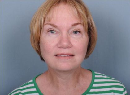 Facelift Before & After Patient #981