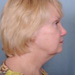 Facelift Before & After Patient #981
