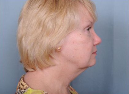 Facelift Before & After Patient #981