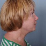 Facelift Before & After Patient #981