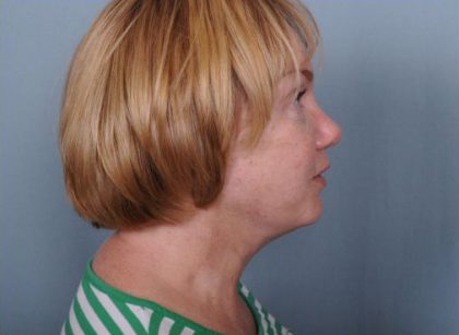 Facelift Before & After Patient #981