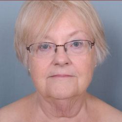 Facelift Before & After Patient #1029