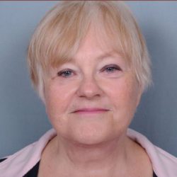 Facelift Before & After Patient #1029