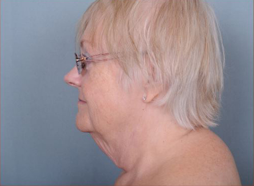 Facelift Before & After Patient #1029