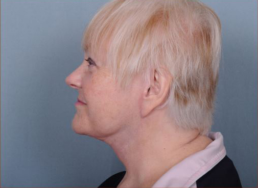 Facelift Before & After Patient #1029