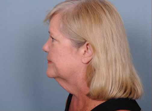 Facelift Before & After Patient #1031