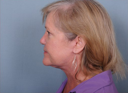 Facelift Before & After Patient #1031