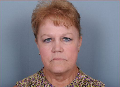 Facelift Before & After Patient #977