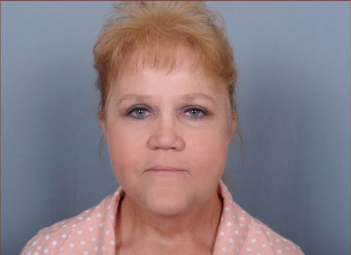 Facelift Before & After Patient #977