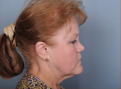 Facelift Before & After Patient #977