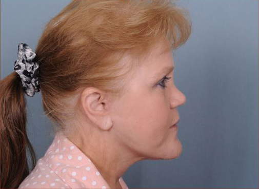 Facelift Before & After Patient #977