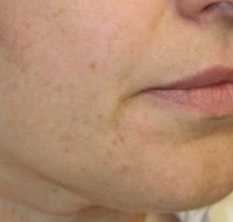 Tattoo Removal New Bern, NC