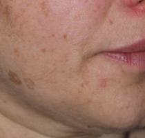 Tattoo Removal New Bern, NC