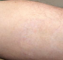 Tattoo Removal New Bern, NC