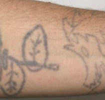 Tattoo Removal New Bern, NC