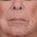 Dermabrasion Before & After Patient #1380