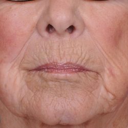 Dermabrasion Before & After Patient #1380