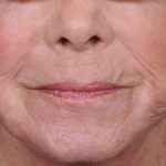 Dermabrasion Before & After Patient #1380