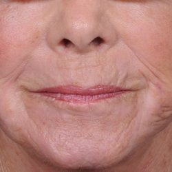 Dermabrasion Before & After Patient #1380