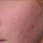Dermabrasion Before & After Patient #1391