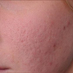 Dermabrasion Before & After Patient #1391