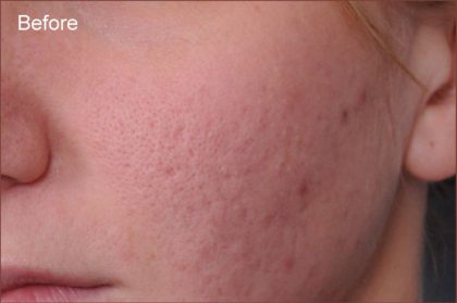 Dermabrasion Before & After Patient #1391