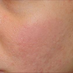 Dermabrasion Before & After Patient #1391