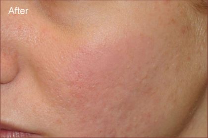 Dermabrasion Before & After Patient #1391