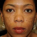 Non-Surgical Before & After Patient #1392