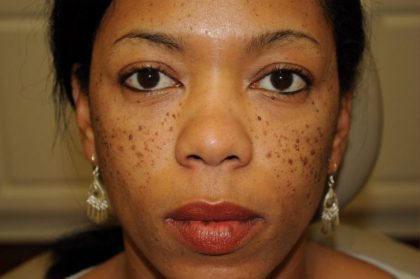 Non-Surgical Before & After Patient #1392