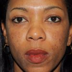 Non-Surgical Before & After Patient #1392
