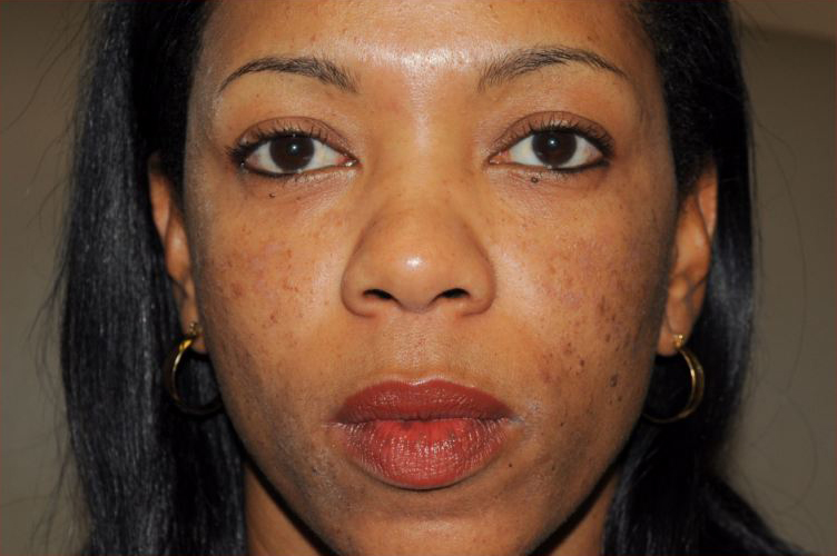Non-Surgical Before & After Patient #1392