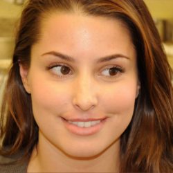 Facial Fillers Before & After Patient #1393