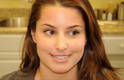 Facial Fillers Before & After Patient #1393