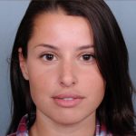 Facial Fillers Before & After Patient #1393