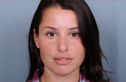 Facial Fillers Before & After Patient #1393