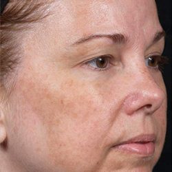 Laser Rejuvenation Before & After Patient #1394