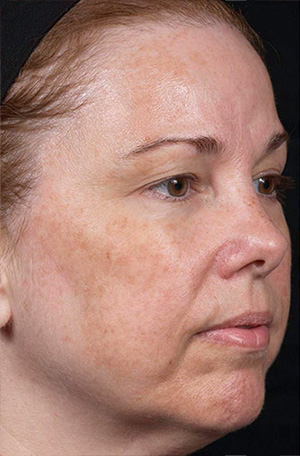 Laser Rejuvenation Before & After Patient #1394