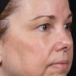 Laser Rejuvenation Before & After Patient #1394