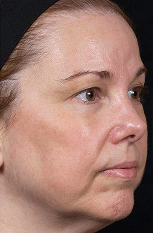 Laser Rejuvenation Before & After Patient #1394