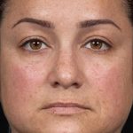 Laser Rejuvenation Before & After Patient #1401