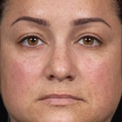 Laser Rejuvenation Before & After Patient #1401