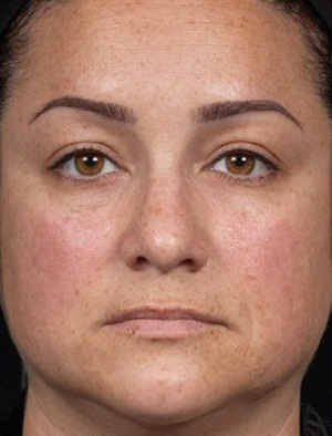 Laser Rejuvenation Before & After Patient #1401