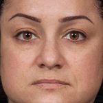 Laser Rejuvenation Before & After Patient #1401